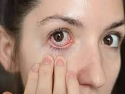 Eye Flu: देश में अचानक क्यों बढ़ने लगे हैं आई फ्लू के मामले, एक्सपर्ट ने बताई ये बड़ी वजह                                                                                                                                                                                                                                                                                                     Eye Flu In India: देश में अचानक क्यों बढ़ने लगे हैं आई फ्लू के मामले, एक्सपर्ट ने बताई ये बड़ी वजह